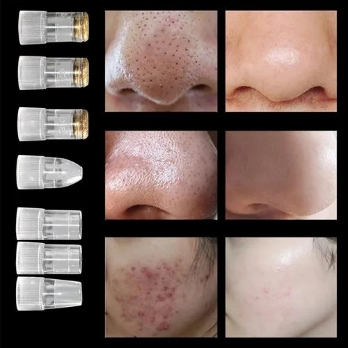 Acné Espinilla De Succión Microdermoabrasión Blackhead Instr