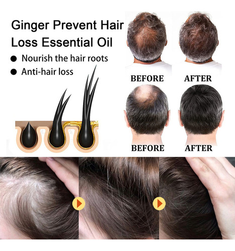 Óleo De Gengibre Para Perda De Cabelo, 20 Ml