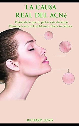 La Causa Real Del Acne Entiende Lo Que Tu Piel Te.., de Lewis, Richard. Editorial Independently Published en español