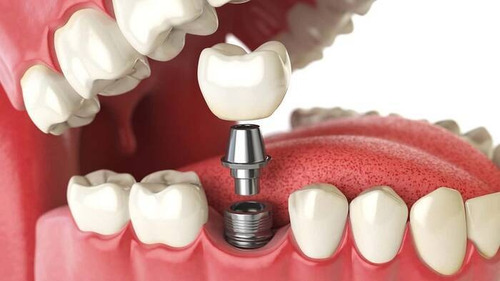 Imagen 3 de 9 de Implantes Dentales. Montevideo, Colonia, San Jacinto