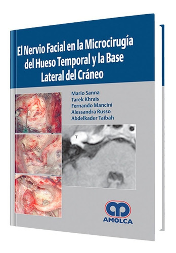 El Nervio Facial En La Microcirugía Del Hueso Temporal Base