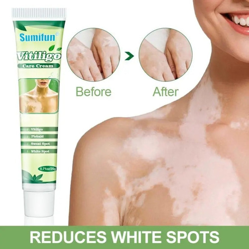 Vitiligo Crema Para Enfermedades Con Manchas Blancas