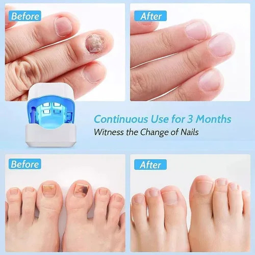 Lâmpada Led Para Fototerapia De Unhas