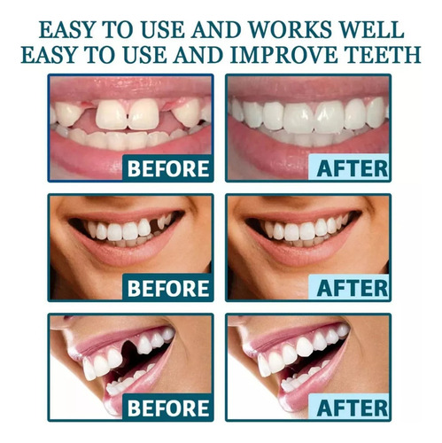 Soportes De Montaje Ajustables Para Dentaduras Temporales