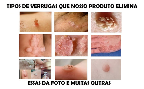 Removedor de Verrugas HPV Único que Elimina la Raíz - 2,5ml