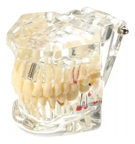 Implante Dental Y Bucal De Ortodoncia Modelo Mannequin