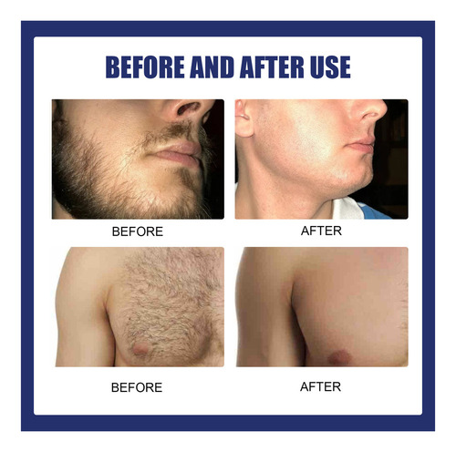 Z Creme De Depilação Permanente: Removedor De Barba E Bigode