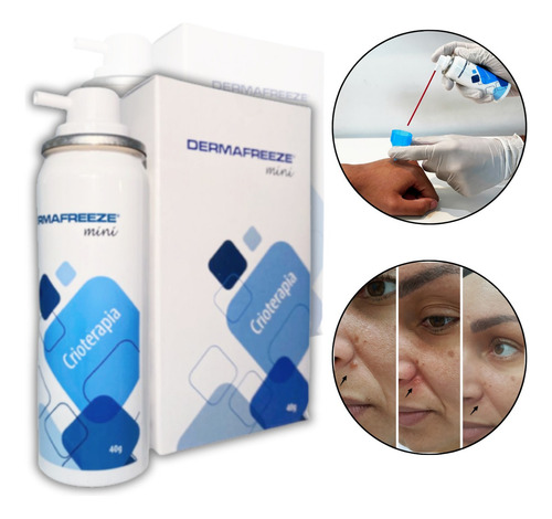 Dermafreeze Funciosa - Testado E Aprovado - Crioterapia Fragrância Sem Cheiro