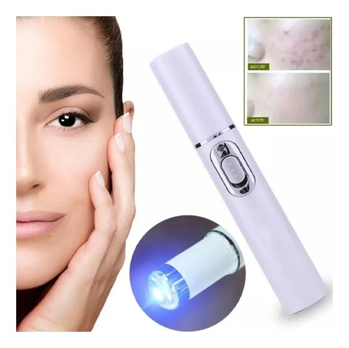 Pluma Láser Portátil Anti Acne - Unidad a $39900