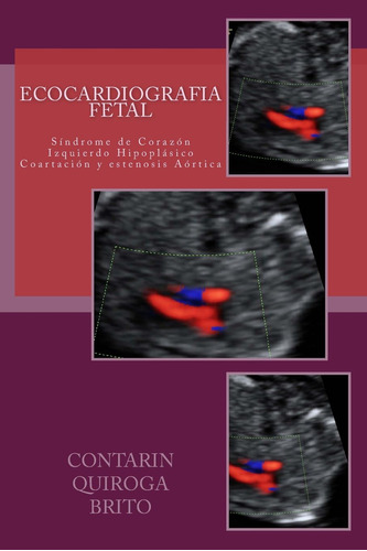 Libro: Ecocardiografia Fetal: Sindrome De Corazón Izquierdo 