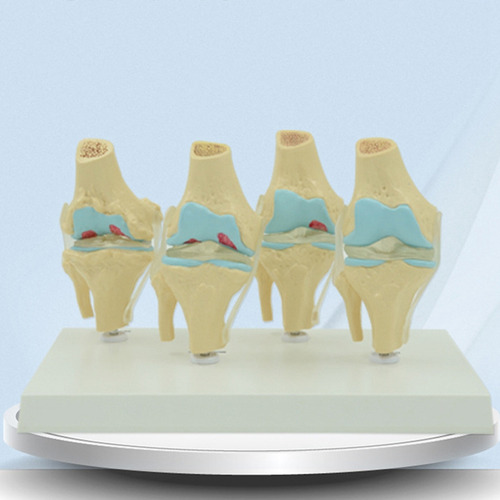 Modelo Anatómico De Articulación Degenerativa De La Rodilla