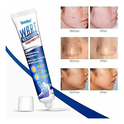Removedor De Verrugas, Vph, 2 Unidades