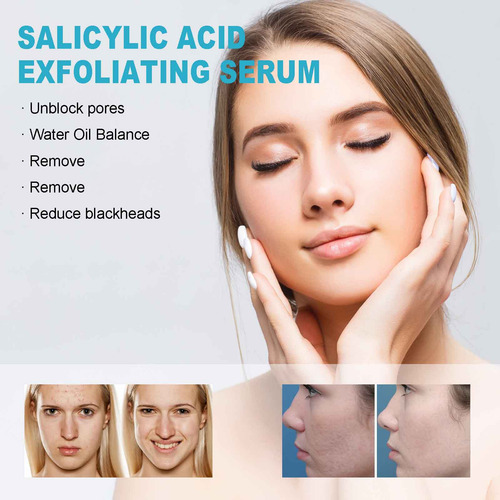 Ácido Salicílico: Esfoliante, Não Perturbado, Poros Minimiza