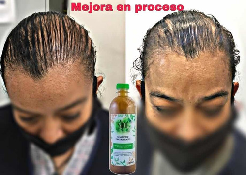 Pack De 3 Shampoos Siloe Contra Calvicie, Caspa, Alopecia.