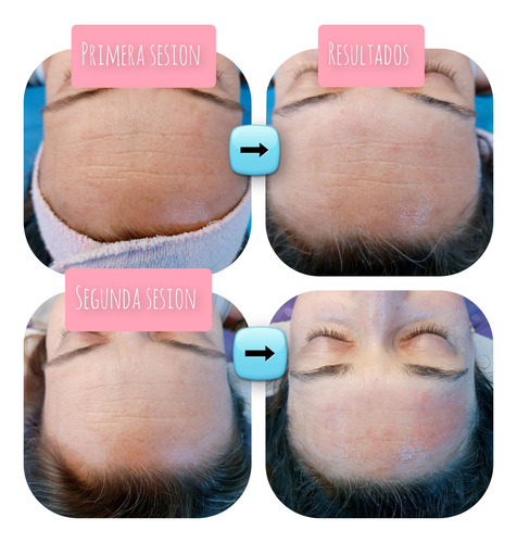 Dermapen Tratamiento Microneedling En Saenz Peña (bs As)
