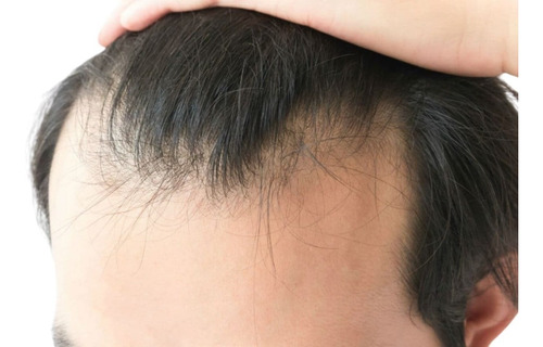 Tratamiento Para Caída De Cabello (mesoterapia)