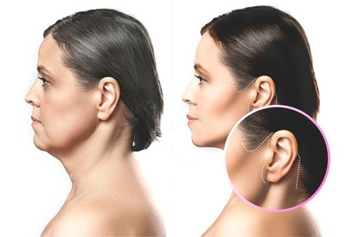 Bandas De Estiramiento Facial