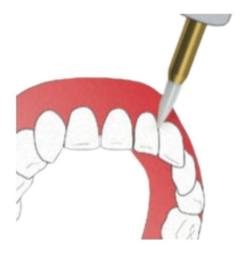 Fresa Para Gingivectomía Dental