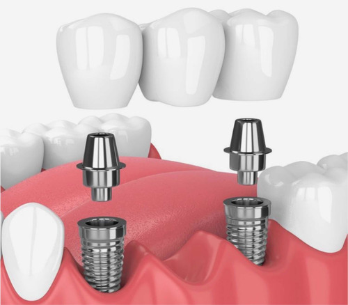 Imagen 4 de 5 de Implantes Dentales . Consulta