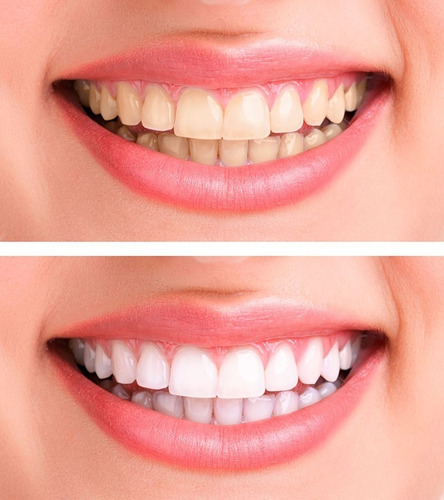 Kit 3 Carvão Em Pó Branqueador Dentes Ativado 100% Natural