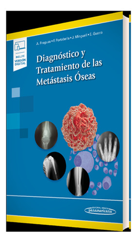 Diagnóstico Y Tratamiento De Las Metástasis Óseas.