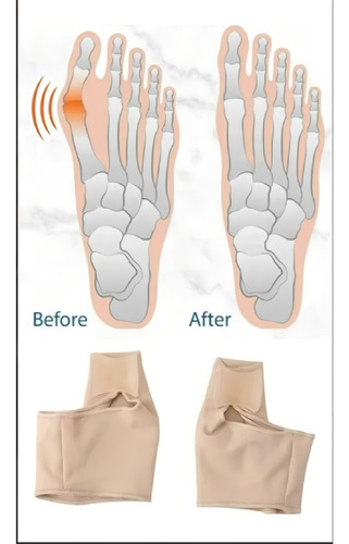 2 Corrector Ortopédico Juanete Dedo Del Pie Separador Valgus