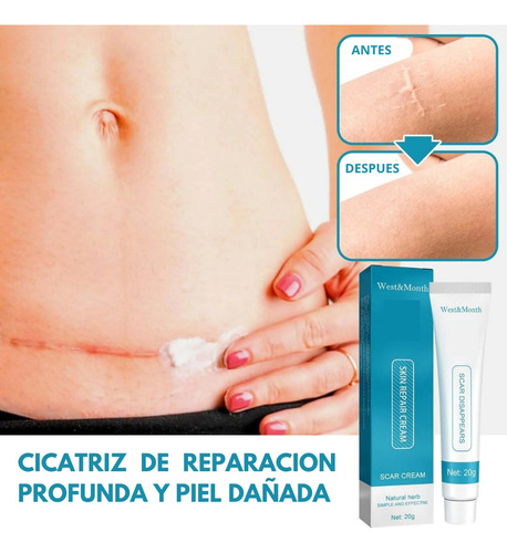 Crema Despigmentante De Manchas Para Cicatrices Paño Acne