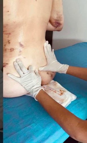 Imagen 3 de 3 de Masajes -pos Operatorios