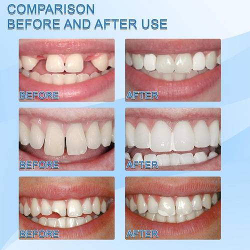Kit De Reparación Temporal De Gránulos O Tooth Whitening Rep