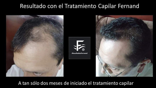 Solución Anticaida Para Hombre Con Cabello Con Caspa