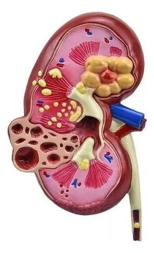 Modelo Anatômico P/ Estudo Rim Com Patologia
