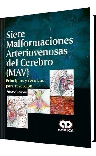 Siete Malformaciones Arteriovenosas Del Cerebro (mav)