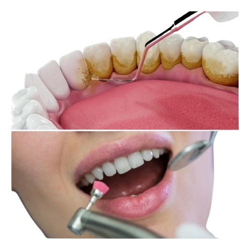 Limpieza Dental Con Ultrasonido + Flúor. Remoción De Sarro.