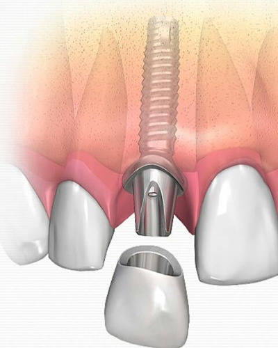 Implante Dental 1ra Marca - Belgrano - Caba