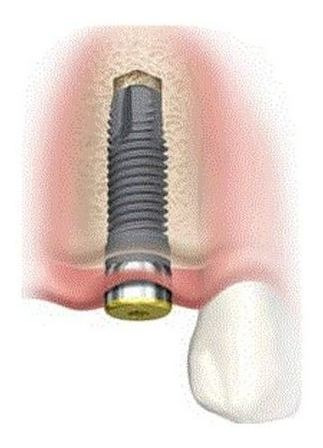 Imagen 1 de 1 de Implante Dental Implantes Dentales