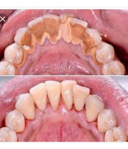 Imagen 3 de 5 de Dentista-odontólogo/limpieza De Sarro