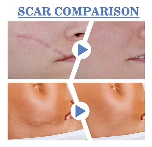 Parche Silicona Reutilizable, Cicatrices, Abdominoplastia