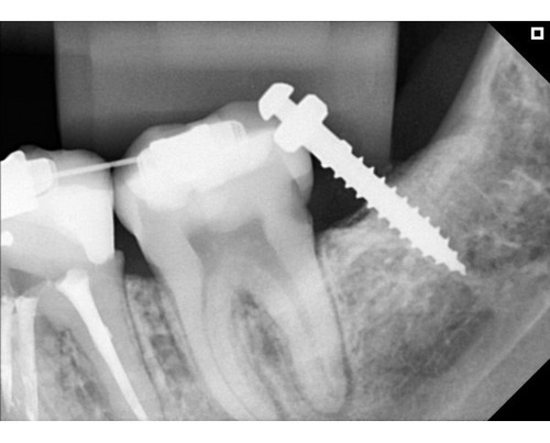 Radiografia Digital Eagle Digital Sensor Dabi Atlante Tam 2