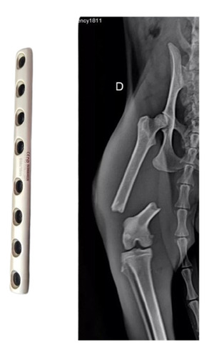 Placas Para Fracturas Traumatología