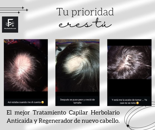 Solución Anticaida Para Hombre Con Cabello Con Caspa