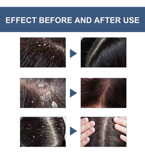 Shampoo De Enxofre Para Controlar A Limpeza De Óleo E Folícu