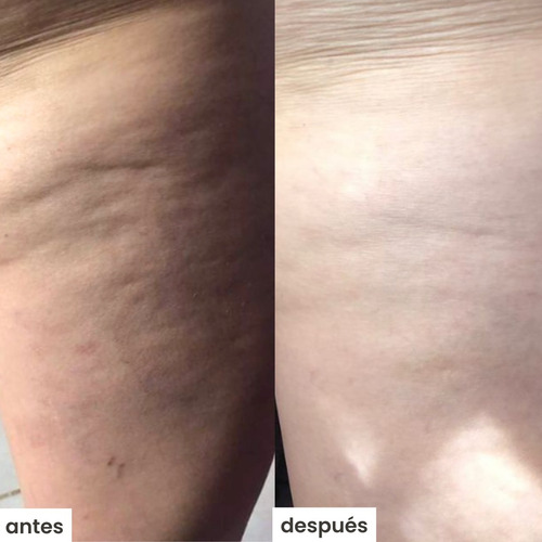 Kit Azala Para Celulitis C/ Azala Brush (si Tienes Várices) Cítrica