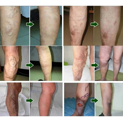 4 Unidades De Creme Anti-varizes, Varizes, Manchas