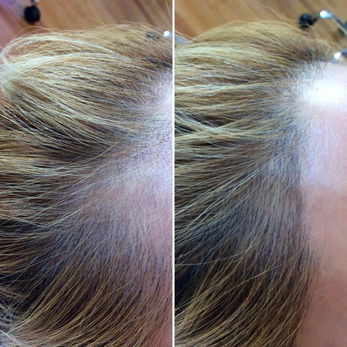 Crescimento Capilar Cabelo Intensivo Coreano Mba Derma Scalp