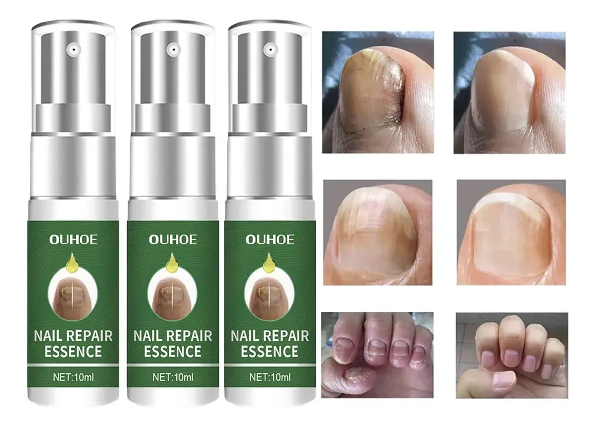 Tratamiento Uñas Alivio Picazón Sequedad Fortalecedor Pack X3