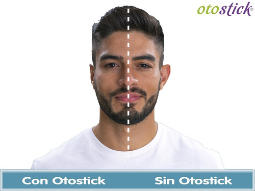 Imagen 5 de 8 de Corrector De Orejas Niños Y Adultos Otostick