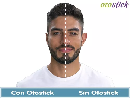 Otostick corrector estético de orejas - Corrige la forma de las
