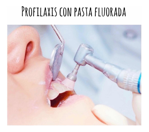 Imagen 2 de 5 de Limpieza Dental En Consultorio Odontologico.