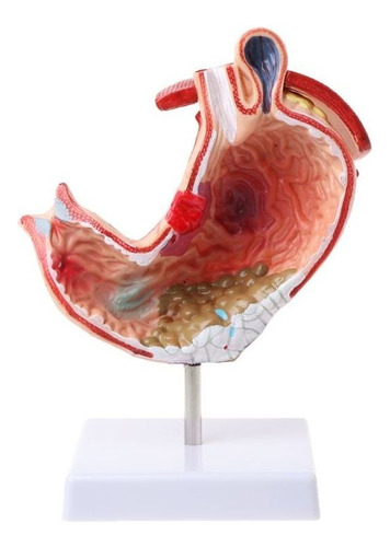 Anatomía Anatómica Humana Modelo Médico Del Estómago Patolog