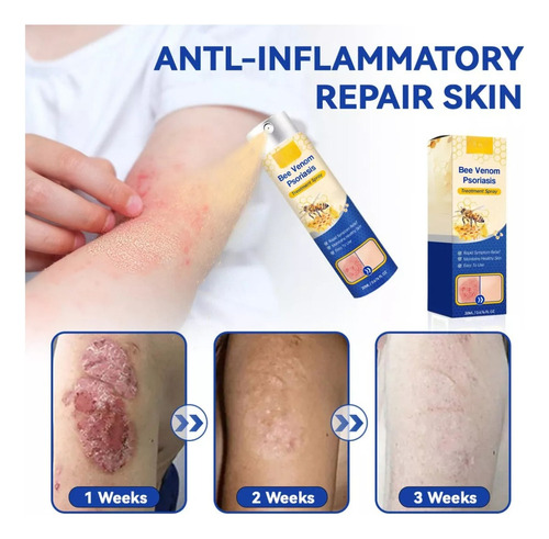 Spray For El Cuidado De La Psoriasis Furzero Psoriaheal Con